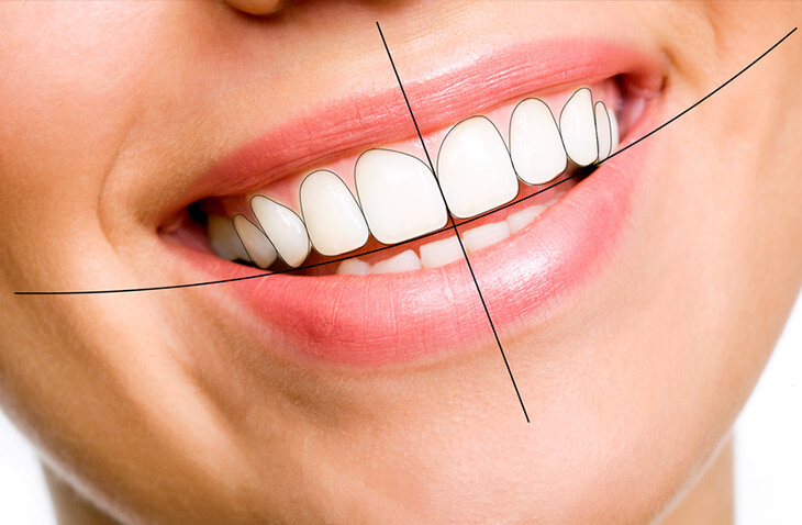 Smile Designing (Veneers)